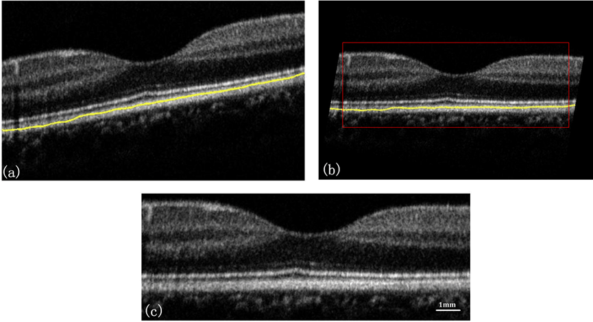 视网膜分层oct结构图片图片